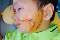 Bé 5 tuổi bị chó cắn vùng mặt, cảnh báo nguy cơ bệnh dại