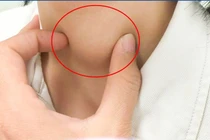 Ung thư tuyến giáp ở trẻ nhỏ diễn tiến nhanh, mức độ ác tính cao