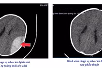 Ngã xe tập đi trẻ 8 tháng tuổi mở sọ cấp cứu giành lại sự sống