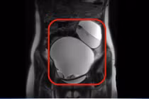 Thiếu nữ 17 tuổi bị u buồng trứng 2 bên choán chỗ, xoắn đe dọa tính mạng