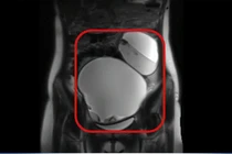 Thiếu nữ 17 tuổi bị u buồng trứng 2 bên choán chỗ, xoắn đe dọa tính mạng