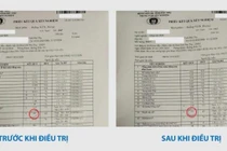 Đau xương cụ ông 78 tuổi không ngờ đa u tủy xương