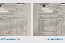 Đau xương cụ ông 78 tuổi không ngờ đa u tủy xương