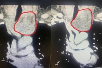 Lấy u tuyến giáp thòng xuống trung thất không cưa xương ức