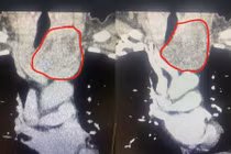 Lấy u tuyến giáp thòng xuống trung thất không cưa xương ức