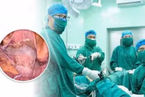 Treo tử cung vào dải chậu lược trị sa sinh dục