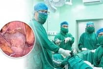 Treo tử cung vào dải chậu lược trị sa sinh dục