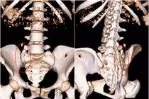 Nắn chỉnh kết hợp xương cứu cô gái nguy kịch do nhảy cầu