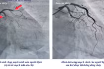 Cụ bà 78 tuổi bất ngờ ngừng tim, truy mạch nguy kịch