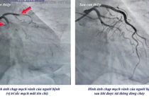 Cụ bà 78 tuổi bất ngờ ngừng tim, truy mạch nguy kịch