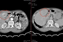 Nút mạch hóa chất cứu người bệnh bị ung thư gan nặng