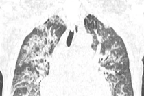 Tổn thương phổi - nguyên nhân hàng đầu gây tử vong liên quan tới truyền máu