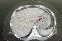 Xương cá đâm thủng, tạo mủ cả tháng trong dạ dày bệnh nhân 56 tuổi
