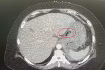 Xương cá đâm thủng, tạo mủ cả tháng trong dạ dày bệnh nhân 56 tuổi