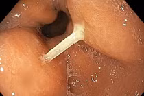 Suýt biến chứng nguy hiểm vì hóc xương cá mà không biết