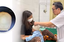 Trẻ hơn 3 tuổi chấn thương sọ não nặng do tai nạn 