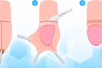 Suýt hoại tử cậu nhỏ vì tự lộn bao quy đầu