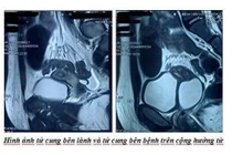Đau bụng đi khám bất ngờ phát hiện có 2 tử cung, 1 quả thận