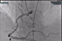 Cảnh báo nhồi máu cơ tim ở người lớn tuổi mắc nhiều bệnh nền phức tạp