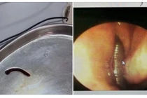 Chảy máu mũi kéo dài không ngờ do đỉa rừng 4cm ở trong mũi