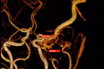 Đau đầu dai dẳng, cô gái 26 tuổi từ Đức về Việt Nam phát hiện rò mạch máu não