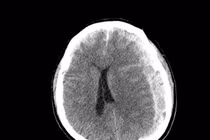 1 giờ sau ngã tại nhà, cụ ông 70 tuổi nhanh chóng hôn mê