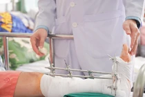 Cách sơ cứu, xử lý chi đứt lìa do máy cắt cỏ 