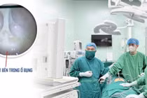 Phẫu thuật cấp cứu thành công vỡ áp xe phần phụ nguy hiểm