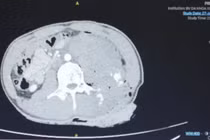 Mâu thuẫn nhỏ, thanh niên 19 tuổi bị đâm từ hông lưng đến bụng dài 15 cm