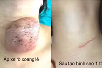 Nội soi đóng rò xoang lê tránh tái phát bệnh cho trẻ