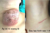 Nội soi đóng rò xoang lê tránh tái phát bệnh cho trẻ
