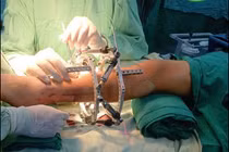 Thiểu xương mác dẫn tới hàng loạt biến dạng ở chi dưới