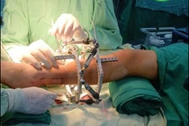 Thiểu xương mác dẫn tới hàng loạt biến dạng ở chi dưới