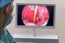 Sau 3 tuần nuốt tăm tre, bé trai 8 tuổi bị dị vật đâm xuyên tá tràng vào gan