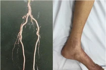 Cụ ông 84 tuổi suýt phải cắt cụt 2 chân do tắc mạch chi nặng nề