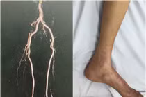 Cụ ông 84 tuổi suýt phải cắt cụt 2 chân do tắc mạch chi nặng nề