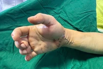 6 giờ vi phẫu nối đôi tay bị chém đứt cho nam TikToker