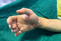 6 giờ vi phẫu nối đôi tay bị chém đứt cho nam TikToker