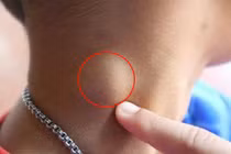 Nổi hạch bất thường, đừng nên chủ quan