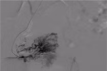 Ra máu âm đạo ồ ạt do bất thường mạch máu tử cung hiếm gặp