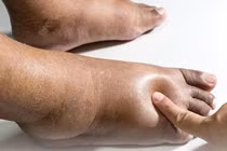 Phòng ngừa biến chứng nguy hiểm của hội chứng thận hư