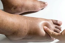 Phòng ngừa biến chứng nguy hiểm của hội chứng thận hư