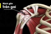 Đau khớp vai cẩn thận teo cơ, vai đông cứng mất chức năng