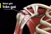 Đau khớp vai cẩn thận teo cơ, vai đông cứng mất chức năng