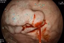 Đau bụng, đầy hơi nhập viện, người đàn ông mới biết bị xuất huyết tiêu hóa 