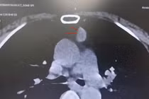 Cắt toàn bộ tuyến ức kèm u cho người phụ nữ 65 tuổi 