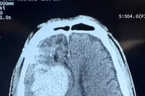 Chấn thương sọ não sau lên cơn động kinh, cách gì phát hiện sớm?