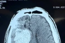 Chấn thương sọ não sau lên cơn động kinh, cách gì phát hiện sớm?