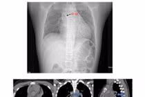 Bé 13 tuổi nguy hiểm tính mạng vì đinh ghim sắc nhọn rơi vào đường thở