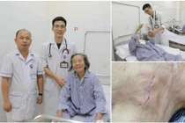 Cụ bà 95 tuổi đột quỵ não được cứu sống nhờ máy tạo nhịp tim